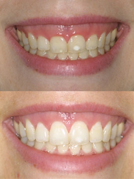 Implant-Periodontal-Associates-NW-Services-CrownLengthing