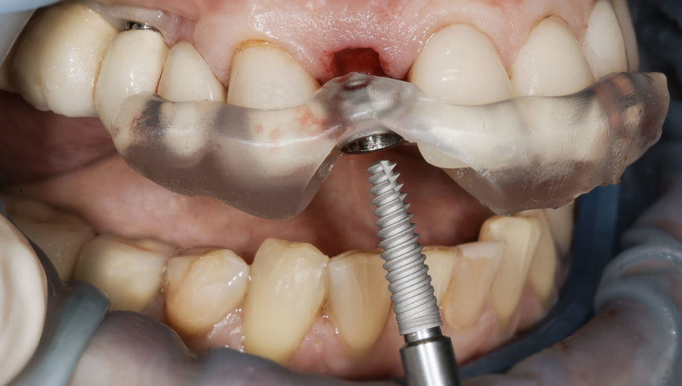 professional installation of high-quality dental implant through