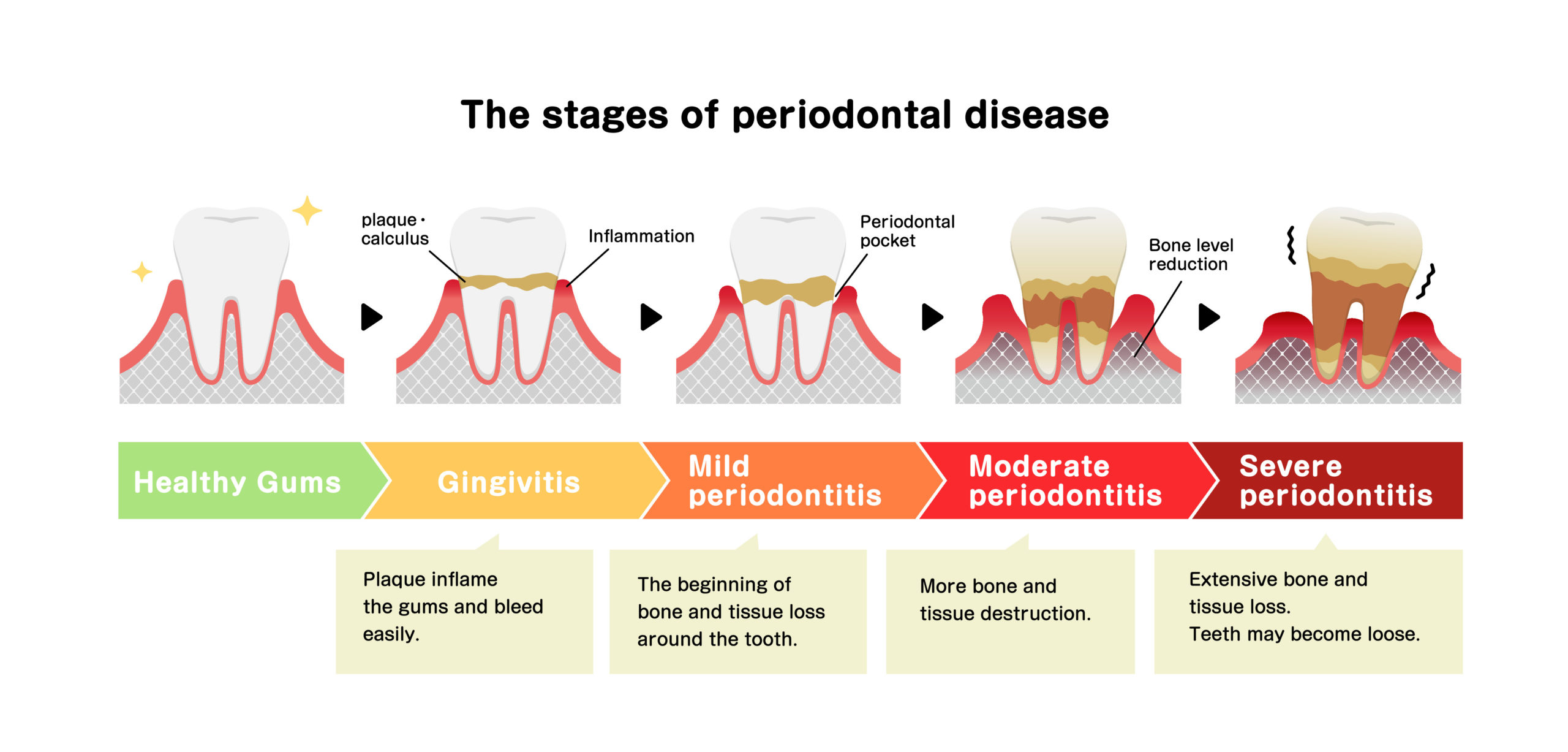 The stages of periodontitis disease vector illustration