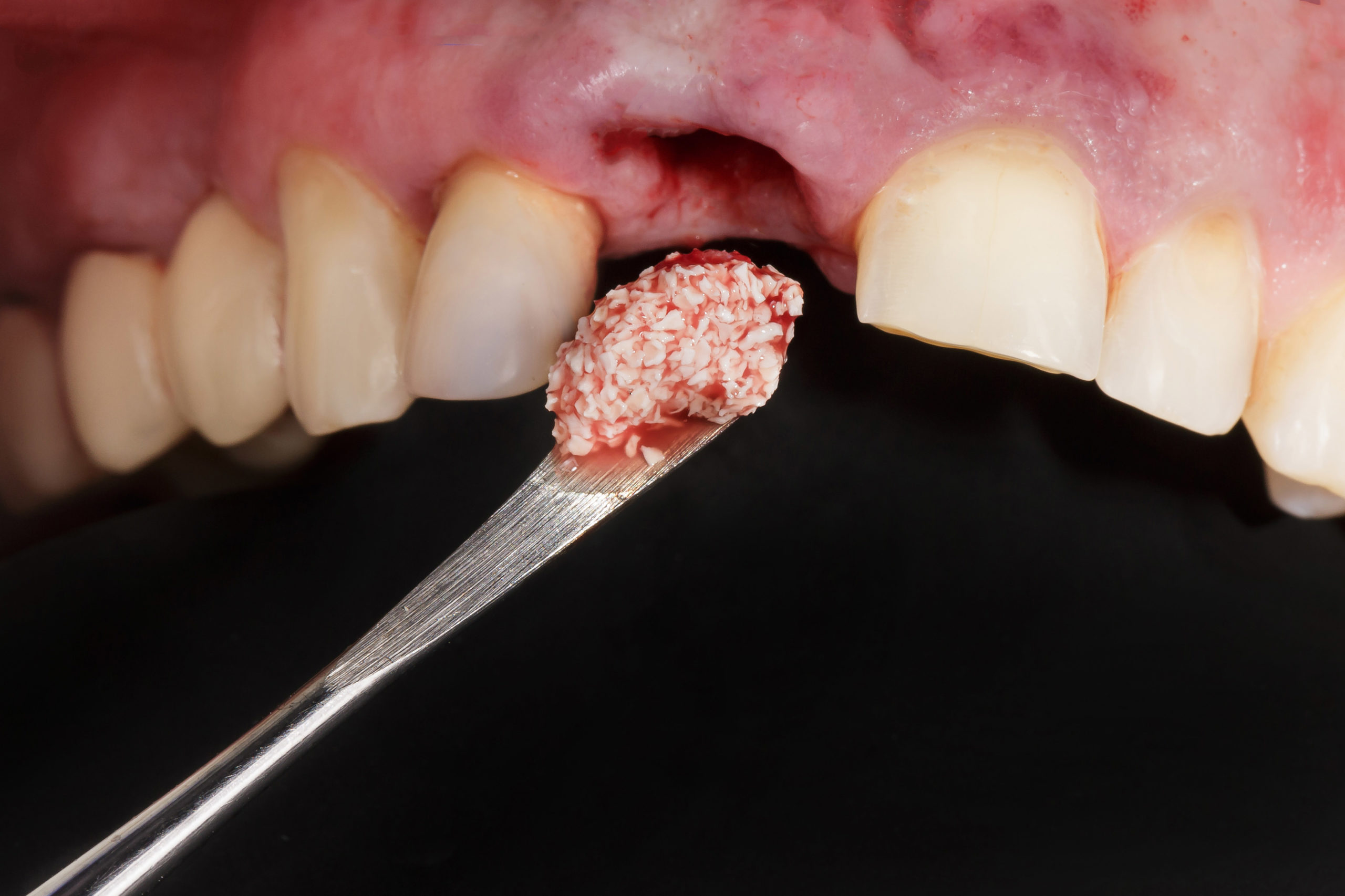 dental procedure, addition of artificial bone, for dental implan
