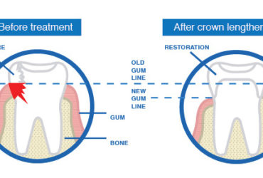 dental-crown-lengthening-procedure