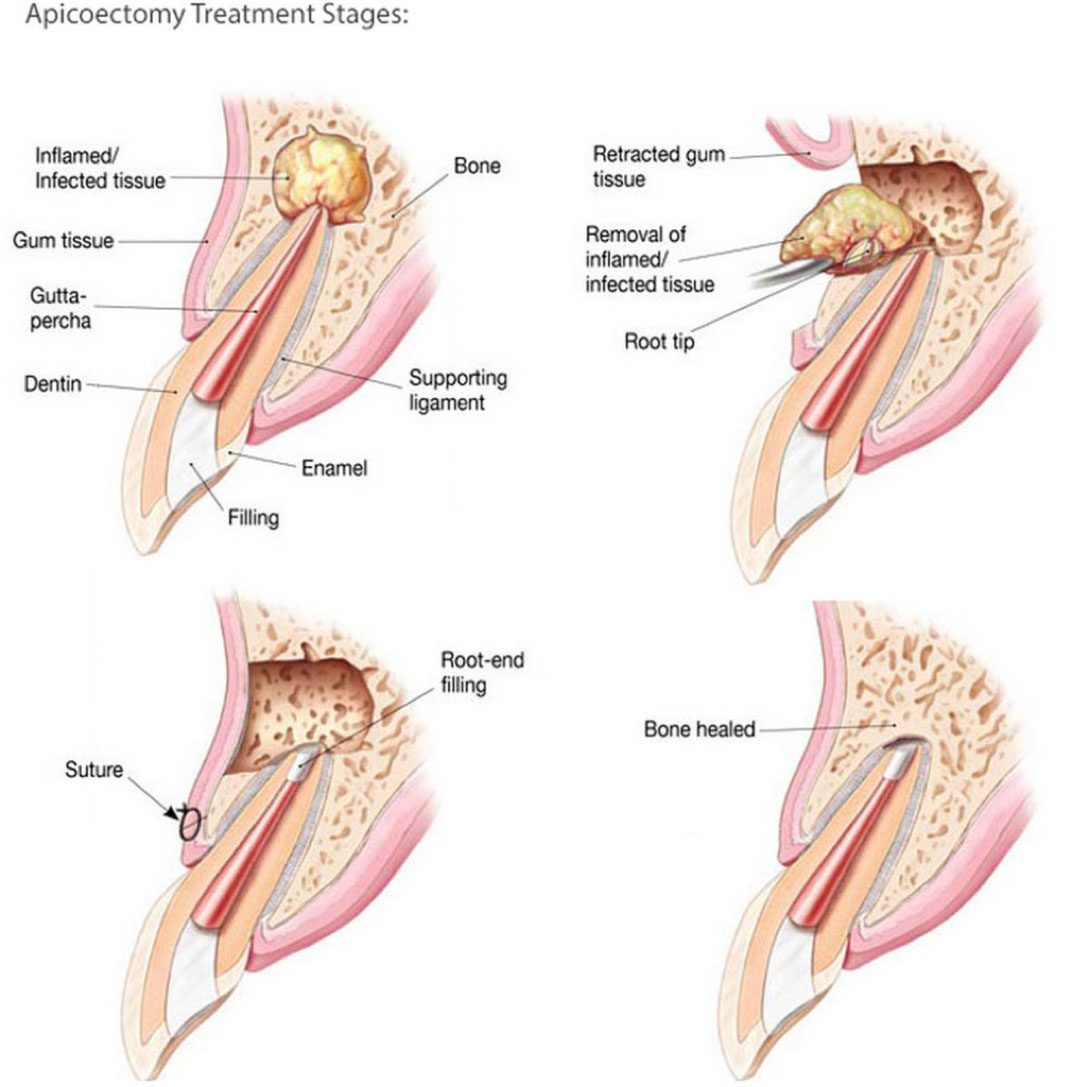 Endodontic-Surgery